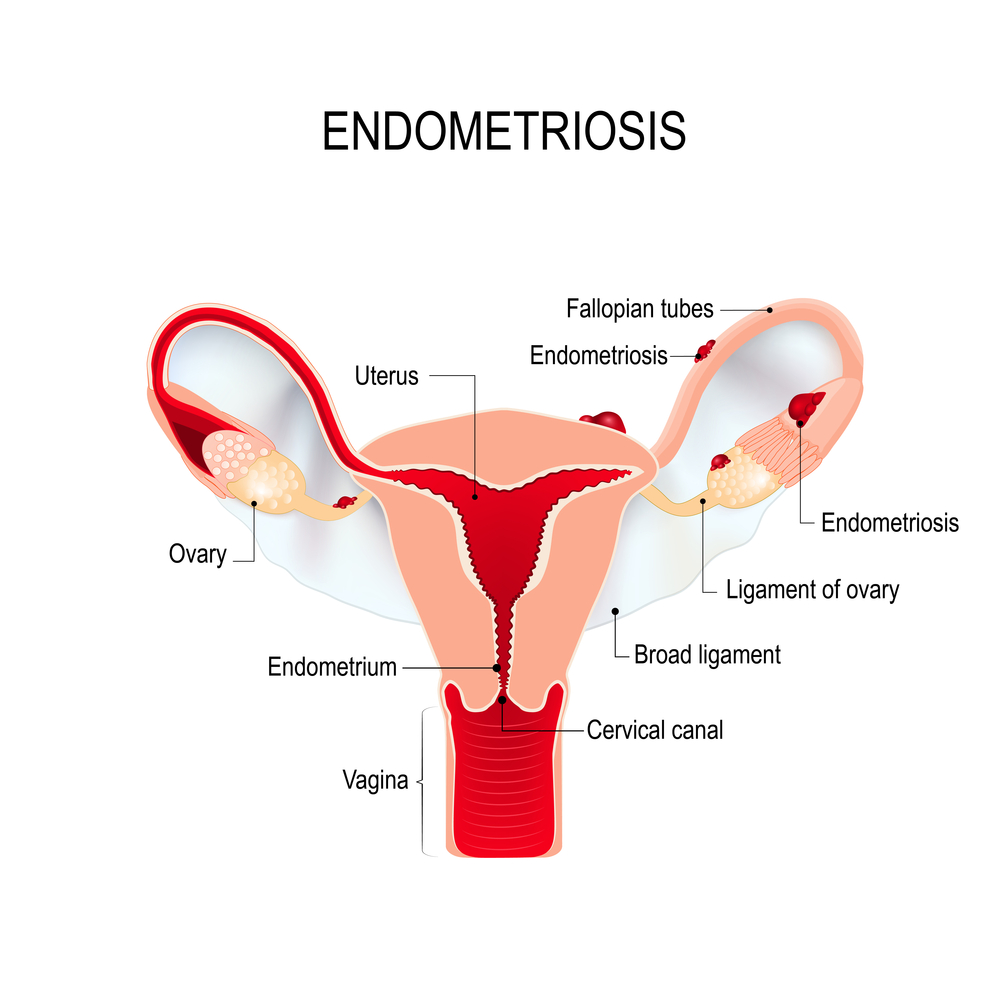 Period Pain What Causes It And How To Tell If It s Normal Marion Gluck