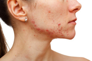 Adult female acne how can hormones help?